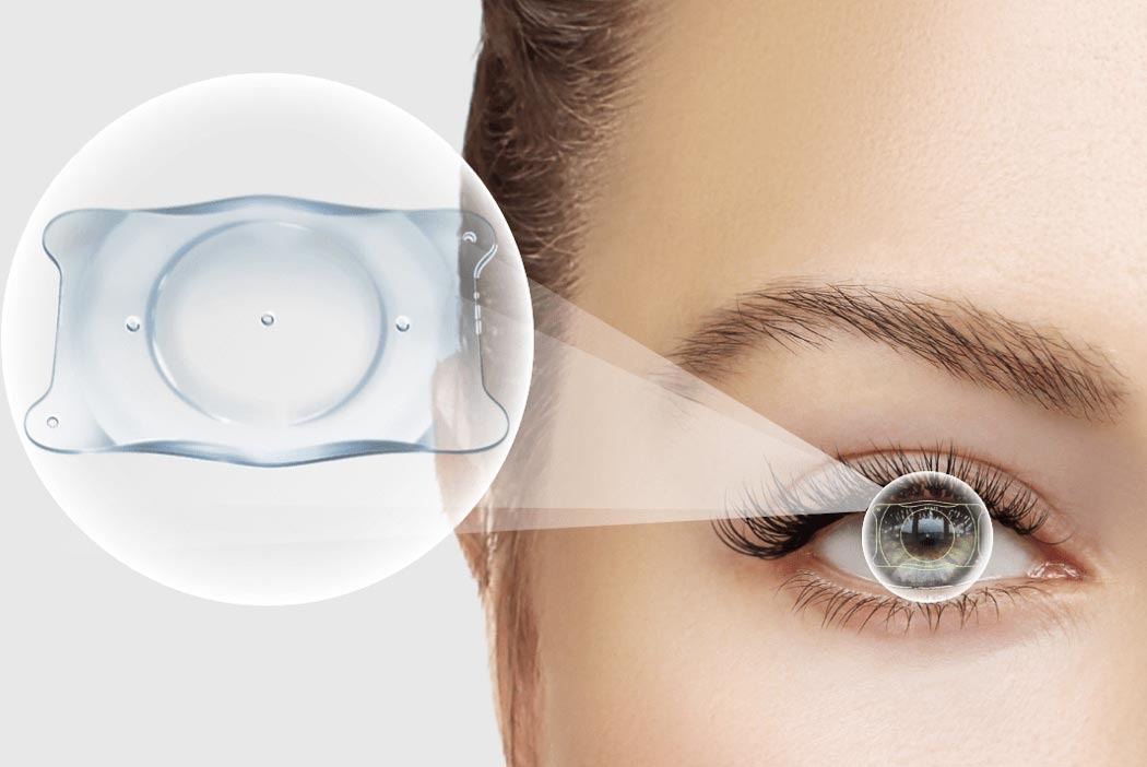 Valoración para lentes ICL